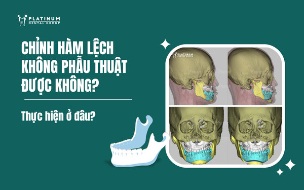 chỉnh hàm lệch không phẫu thuật