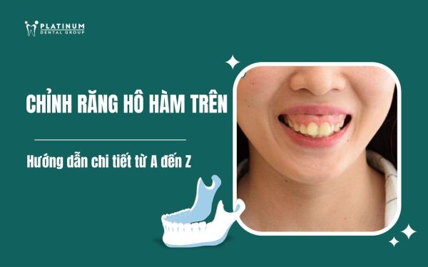 chỉnh răng hô hàm trên