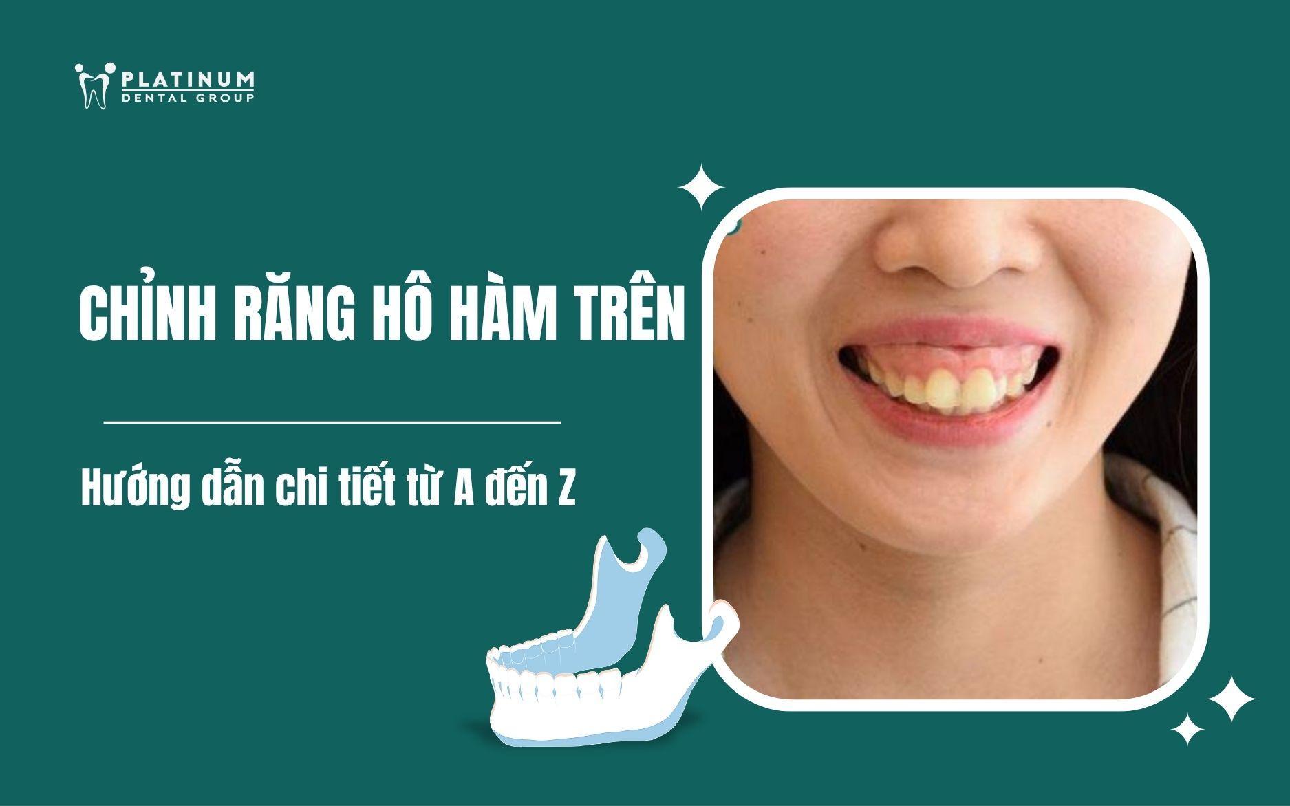 chỉnh răng hô hàm trên