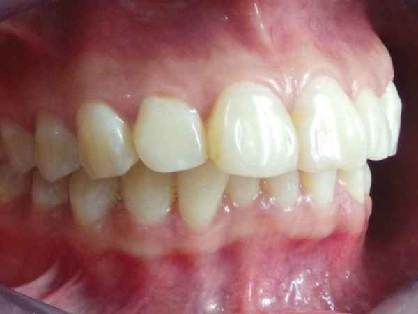 Hô hàm trên là tình trạng khi răng, xương hàm hoặc cả hai nhô ra phía trước, gây mất cân đối khuôn mặt