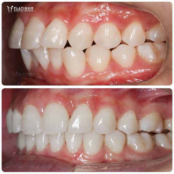 Những dấu hiệu dễ nhận biết tình trạng hô hàm trên