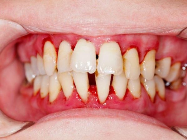 Có nên bọc răng sứ không? Khi nào nên và không nên làm? 6 Răng yếu, dễ lung lay không nên bọc răng sứ