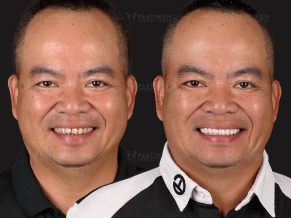 Có nên bọc răng sứ không? Khi nào nên và không nên làm? 5 Bọc sứ cho trường hợp răng xỉn màu, ố vàng nặng