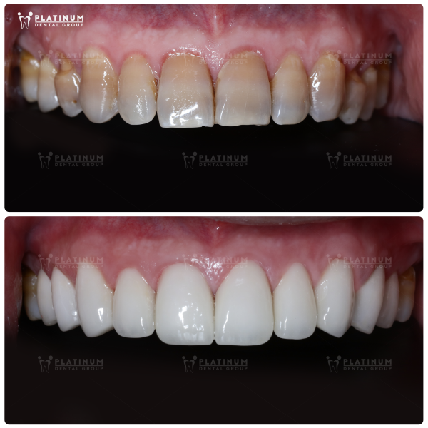 Có nên bọc răng sứ không? Khi nào nên và không nên làm? 1 Bọc răng sứ giúp phục hồi răng sâu giúp ăn nhai chắc khỏe và bảo vệ răng đã chữa tủy