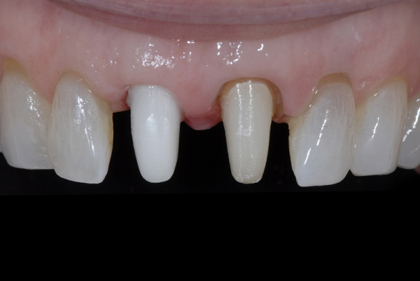 Những trường hợp bác sĩ sẽ chỉ định làm cùi giả