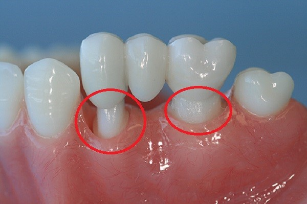 Cùi giả toàn sứ Zirconia có màu trắng ngà tự nhiên, mang lại tính thẩm mỹ vượt trội và tương thích sinh học cao, đặc biệt phù hợp cho vùng răng cửa