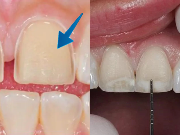 Đắp răng sứ là giải pháp thẩm mỹ nhẹ nhàng giúp bạn lấy lại nụ cười tự tin mà không cần mài răng. Phương pháp này bảo tồn tối đa răng thật, đảm bảo an toàn và hiệu quả