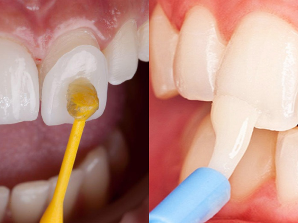 Đắp răng sứ là phương pháp thẩm mỹ nha khoa giúp phục hồi các răng bị sứt mẻ