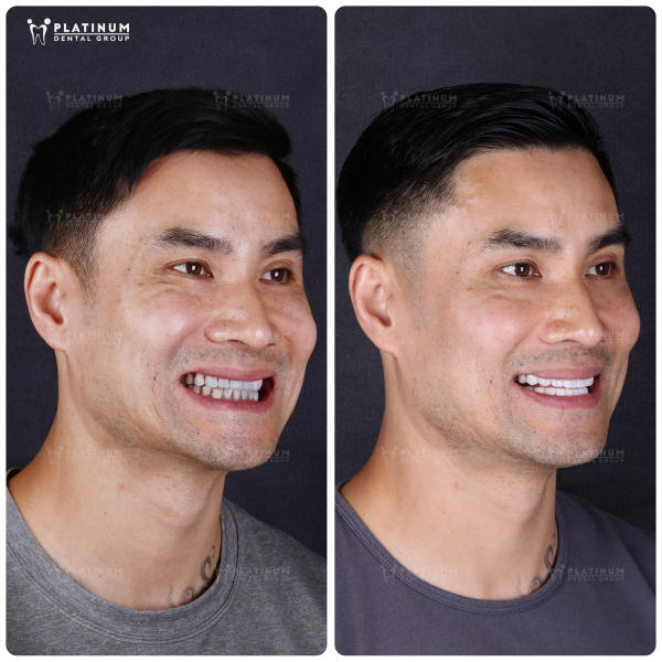 How Much Do Dental Crowns Cost in Ho Chi Minh City? (Updated 2025 Guide) 9 See the customer's real-life smile created at Platinum Dental Group