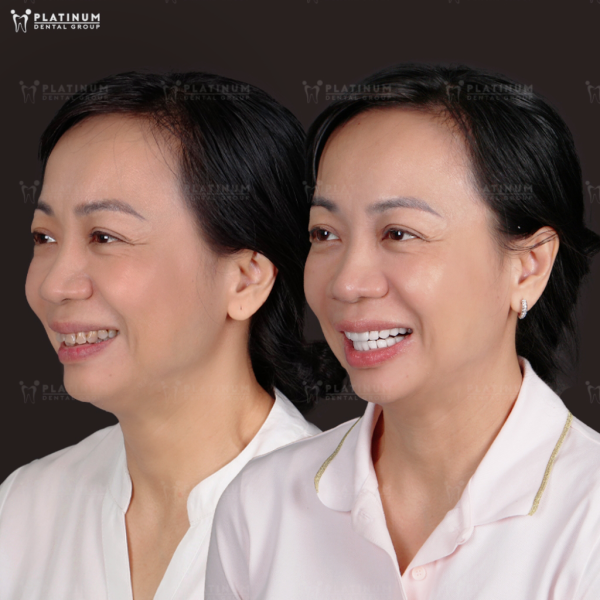 How Much Do Dental Crowns Cost in Ho Chi Minh City? (Updated 2025 Guide) 8 See the real-life smiles created