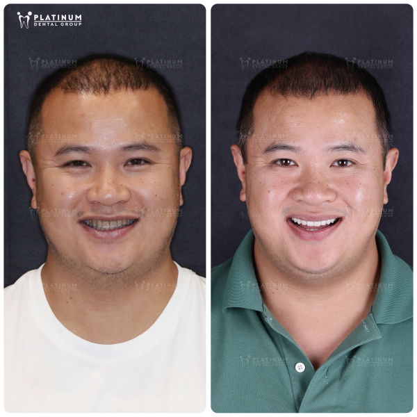 How Much Do Dental Crowns Cost in Ho Chi Minh City? (Updated 2025 Guide) 10 the real-life smiles created at Platinum Dental Group