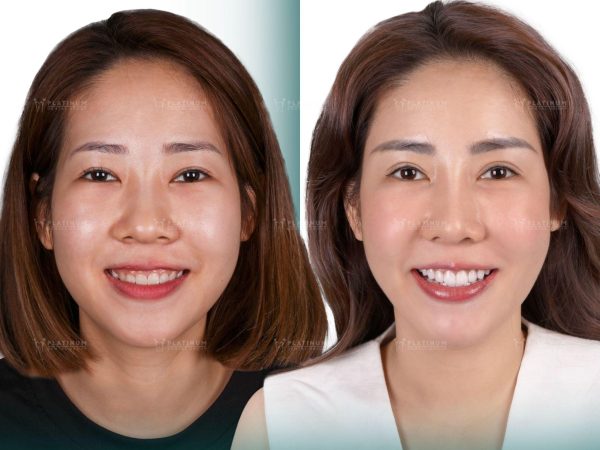 Learn About the Pros and Cons of Dental Veneers 2 After the Veneer application is complete, you can completely eat, chew, and communicate naturally as before