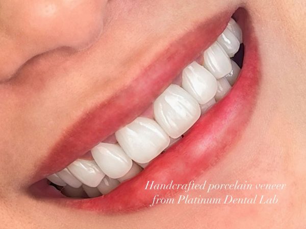 Learn About the Pros and Cons of Dental Veneers 1 Dental Veneers can fix most common imperfections such as discolored, stained teeth, etc.