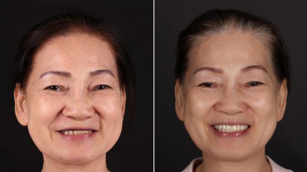 Applying a cold compress to the cheek area near the Implant helps reduce swelling and numb discomfort