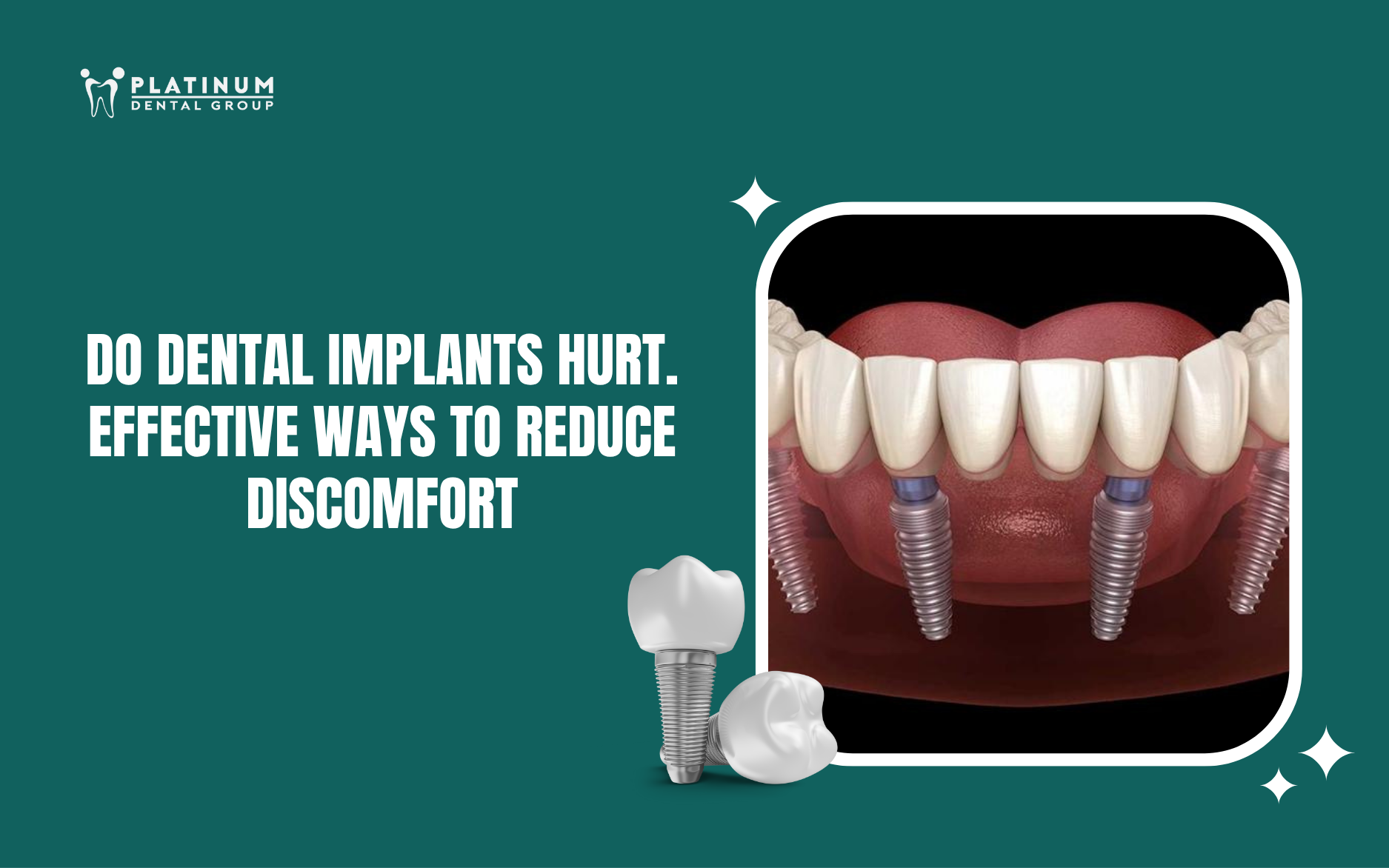 do dental implants hurt