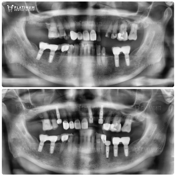 How long does it take for the pain to go away after getting a dental implant?