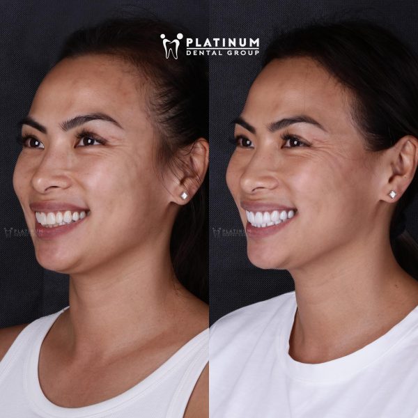 Showcase of customers using porcelain veneer service at Platinum Dental
