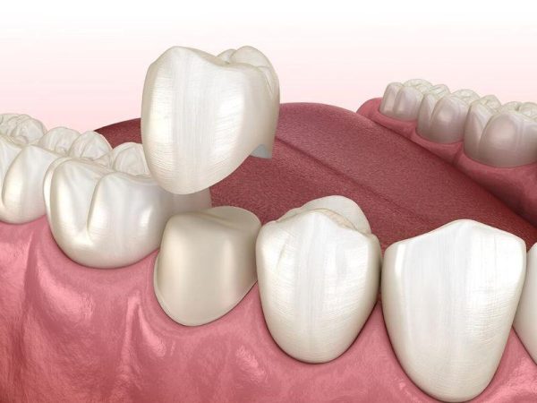 Porcelain crowns are completely painless if done properly at a reputable dental clinic