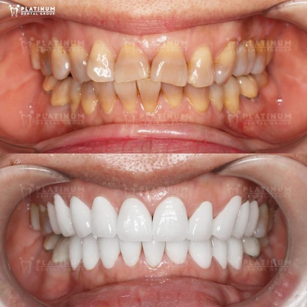 Customer's porcelain showcase at Platinum Dental Clinic