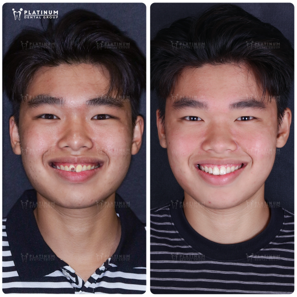 Before & After dental crowns at Platinum Dental Group – Restoring a confident, bright, and naturally harmonious smile