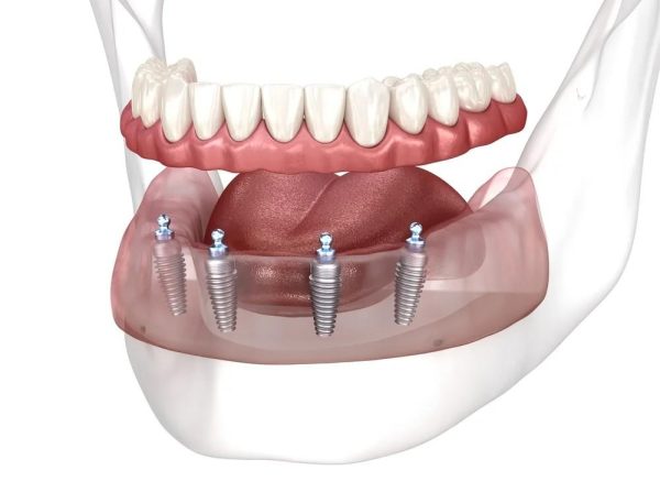 Hàm Tháo Lắp Trên Implant: Giải Pháp Nào Tốt Nhất Cho Người Mất Răng? 1 Hàm tháo lắp trên Implant là giải pháp hoàn hảo cho người mất răng