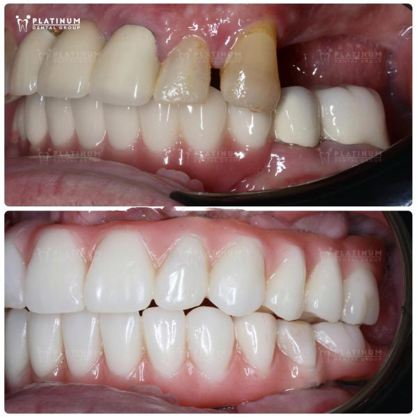 Mr. David đã tự tin trở lại nhờ phục hình toàn hàm trên dưới bằng Implant