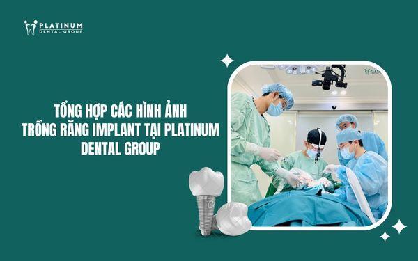 hình ảnh trồng răng implant