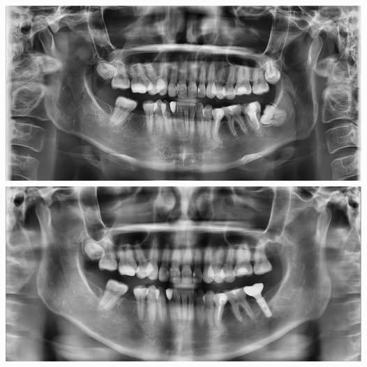 Bệnh nhân không còn e ngại khi giao tiếp, sau khi phục hồi răng cối bằng Implant, chấm dứt tình trạng nhồi nhét thức ăn và viêm lợi kéo dài