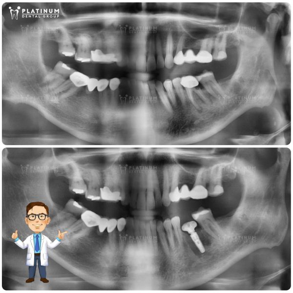 Cắm Implant tức thì sau khi nhổ răng nhiễm trùng, đảm bảo tiến độ nhanh chóng, an toàn và thẩm mỹ