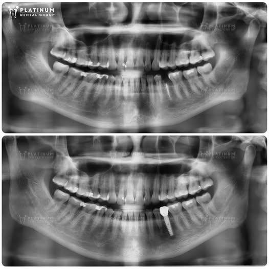 Bệnh nhân đã lấy lại sự thoải mái khi ăn uống và giao tiếp nhờ một chiếc Implant đơn lẻ vững chắc, khôi phục hoàn hảo răng hàm dưới sau thời gian dài bị tiêu xương