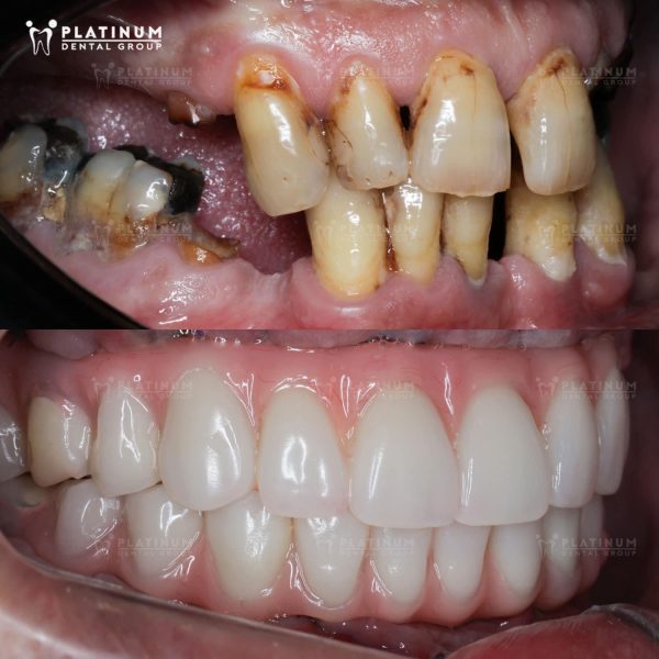 Mr. James Harrison thay đổi toàn diện với các trụ Implant cho hai hàm, lấy lại chức năng ăn nhai và nụ cười tự nhiên đúng như mong đợi