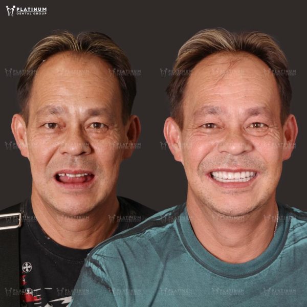 Chú Tuấn tìm lại được chất lượng sống sau nhiều năm mất răng, với hàm răng chắc khỏe từ Implant và nụ cười không còn e ngại