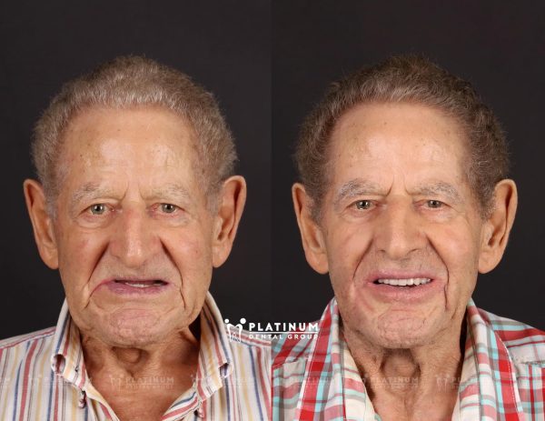 Mr. Mario rạng rỡ với hàm răng mới đều đẹp, trắng sáng nhờ cấy ghép Implant All-on-6 - kết thúc chuỗi ngày khó ăn nhai