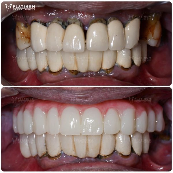 Anh Phúc vượt qua thách thức nhiễm trùng và tiêu xương để có ngay răng tạm thẩm mỹ sau cấy ghép Implant tức thì