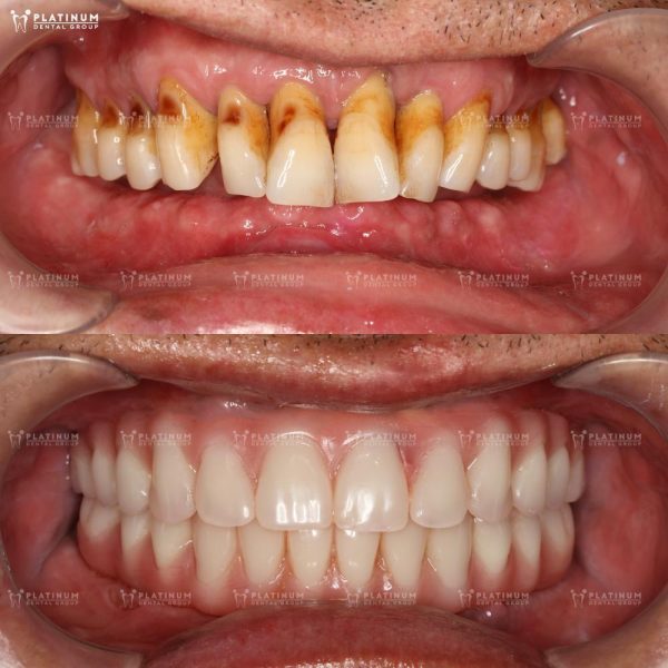 Trồng Implant toàn hàm giúp chú Tuấn lấy lại hàm răng chắc khỏe và thẩm mỹ tự nhiên