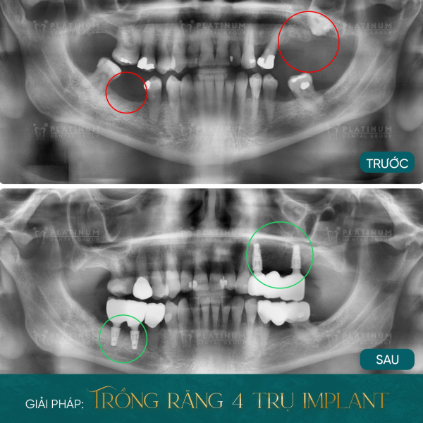 Mr. Raymond đã tìm lại sự thoải mái trong ăn uống và giao tiếp với 4 chiếc Implant đơn lẻ chắc chắn, thẩm mỹ tự nhiên