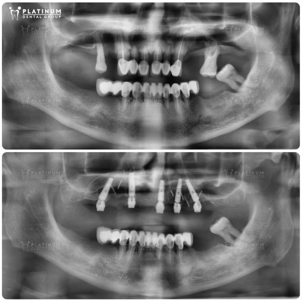 Hình ảnh trên phim x-quang trước và sau cắm Implant của anh Phúc