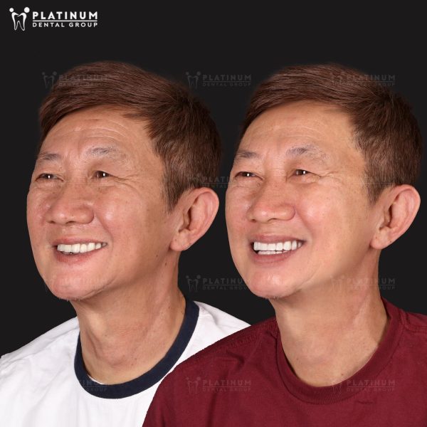 How long after tooth extraction can an implant be placed? Answer from the doctor 5 Platinum Dental Group always accompanies you on your journey to restore your perfect smile