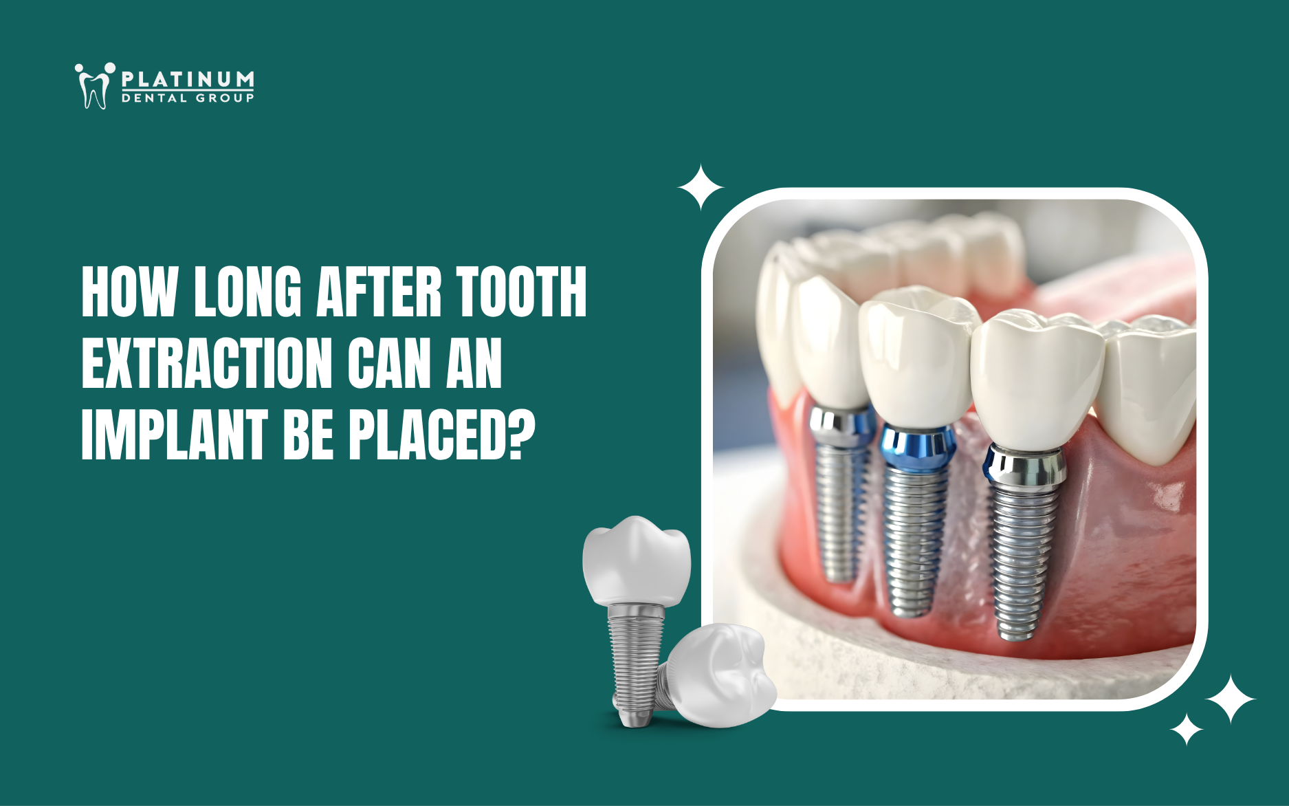 how long after tooth extraction can an implant be placed