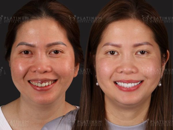 How long does a crown take? Learn the process and important notes about porcelain teeth 6 After getting your dental restoration, you can typically return to comfortable, normal chewing within just a few days of adaptation