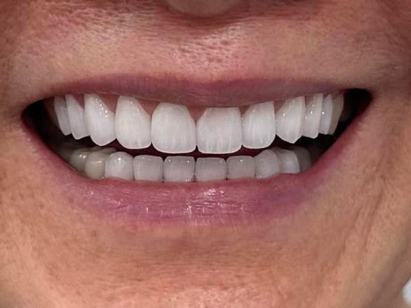 How long does a crown take? Learn the process and important notes about porcelain teeth 1 The time it takes to make porcelain teeth will depend on many different factors