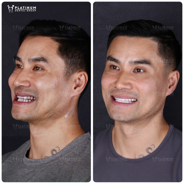 How long does a crown take? Learn the process and important notes about porcelain teeth 7 Platinum Dental Group - The modern technology and leading expertise in porcelain dental restoration converge