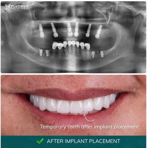 The healing process of the implant will take place in specific stages