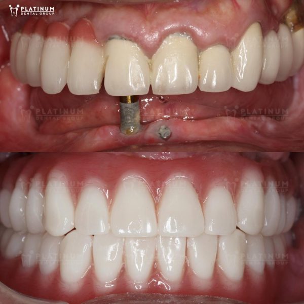 Attach abutment and porcelain crown, complete restoration of lost teeth