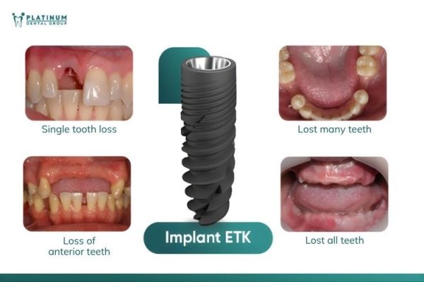 The type of implant and the technology used directly affect the healing rate