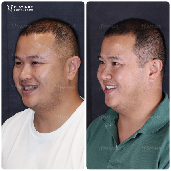 The doctor's skills and experience play an important role in shortening the time of dental implant placement