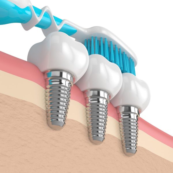 Lifelong care is the key to the 98% success rate of dental implants