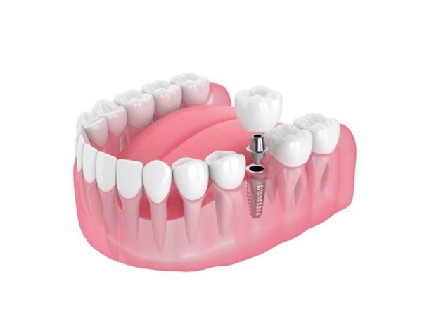 Saving bone and time with immediate tooth replacement