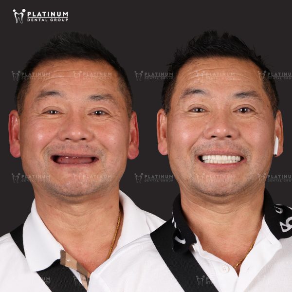 Immediate Implants, exclusively at Platinum Dental Group