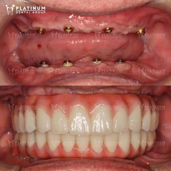 The number of implanted teeth affects the cost of Korean dental implants